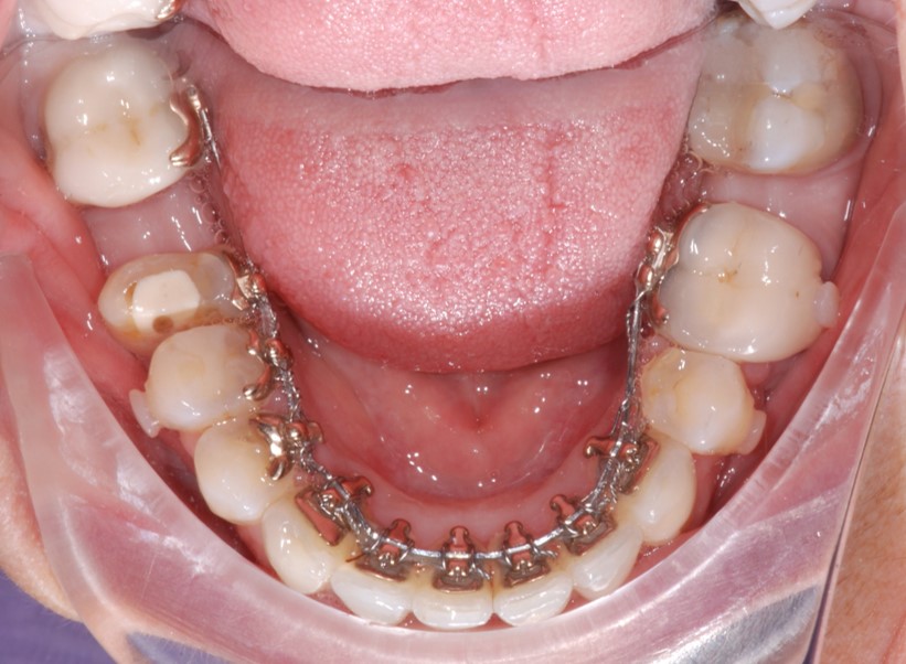 Ortodonzia Linguale Paola Polacco